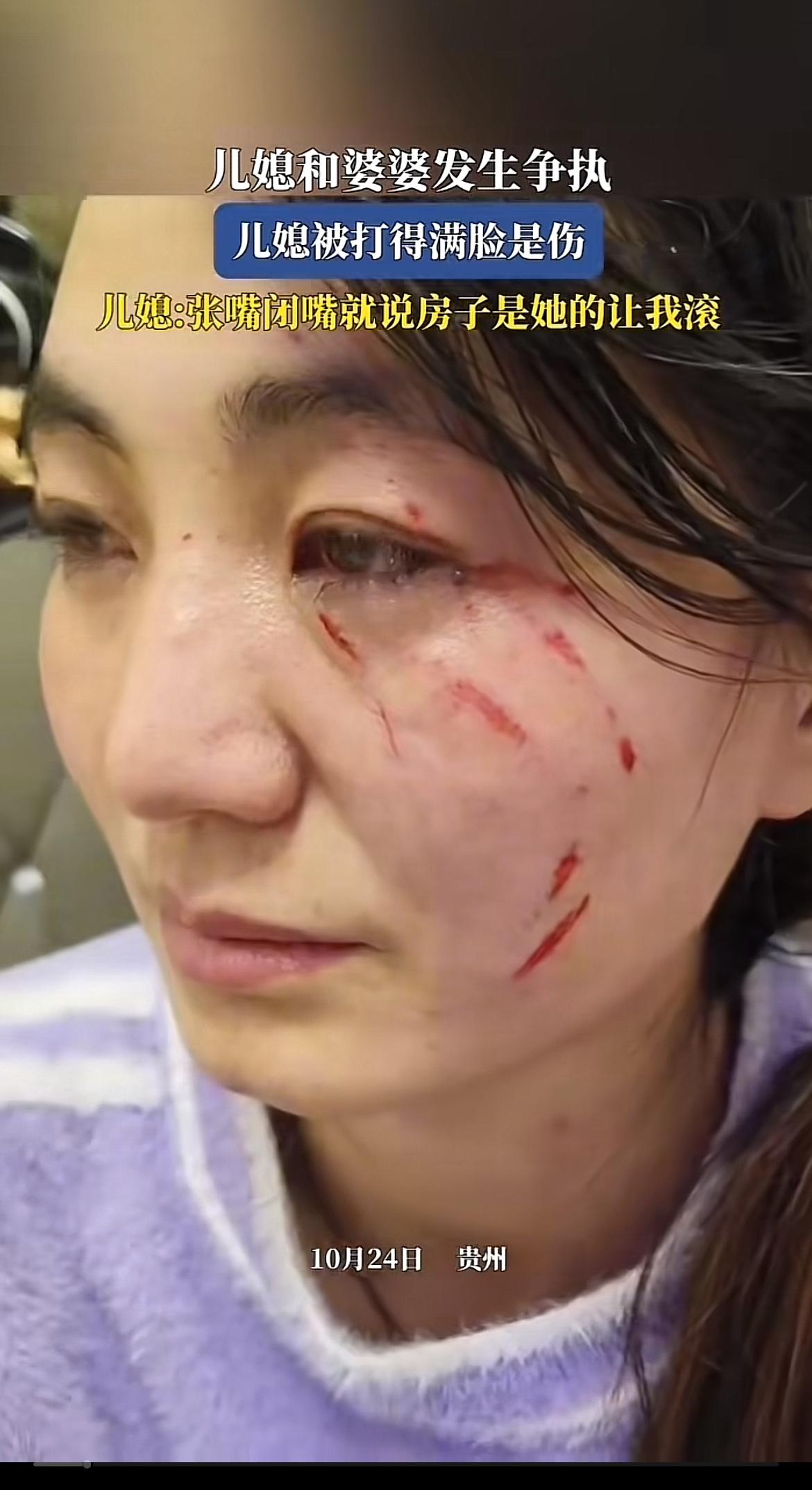 婆媳争吵后儿媳满脸伤痕，想想都让人心碎。3月26日四川广安一女子被婆婆当街殴打，