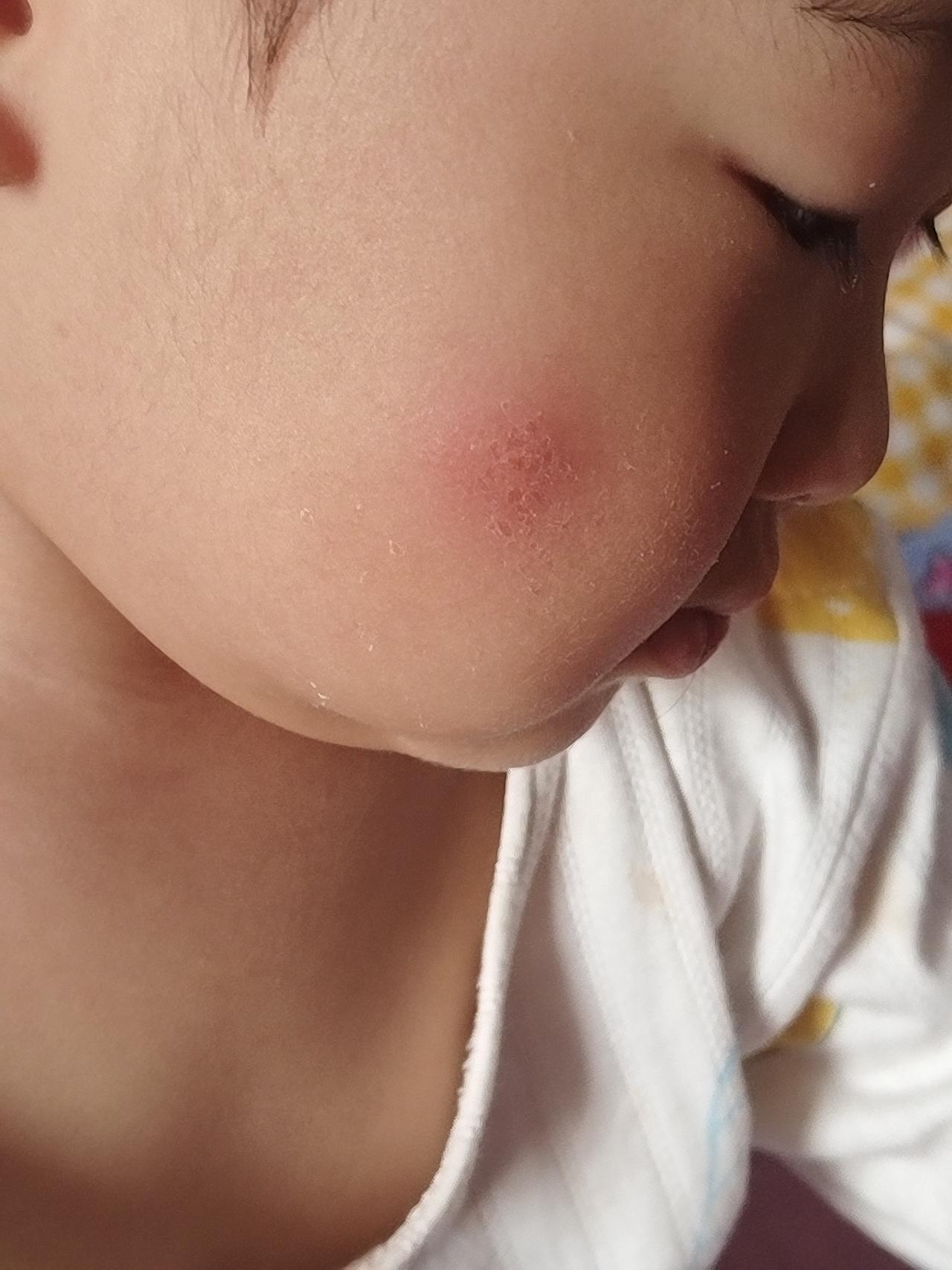 早上起床后发现宝宝脸上不知被啥咬了个硬红点，应该抹什么能消除？
