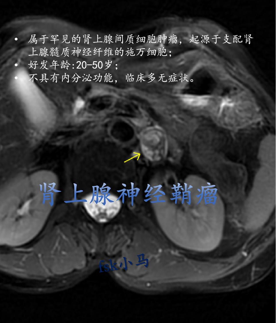 肾上腺神经鞘瘤