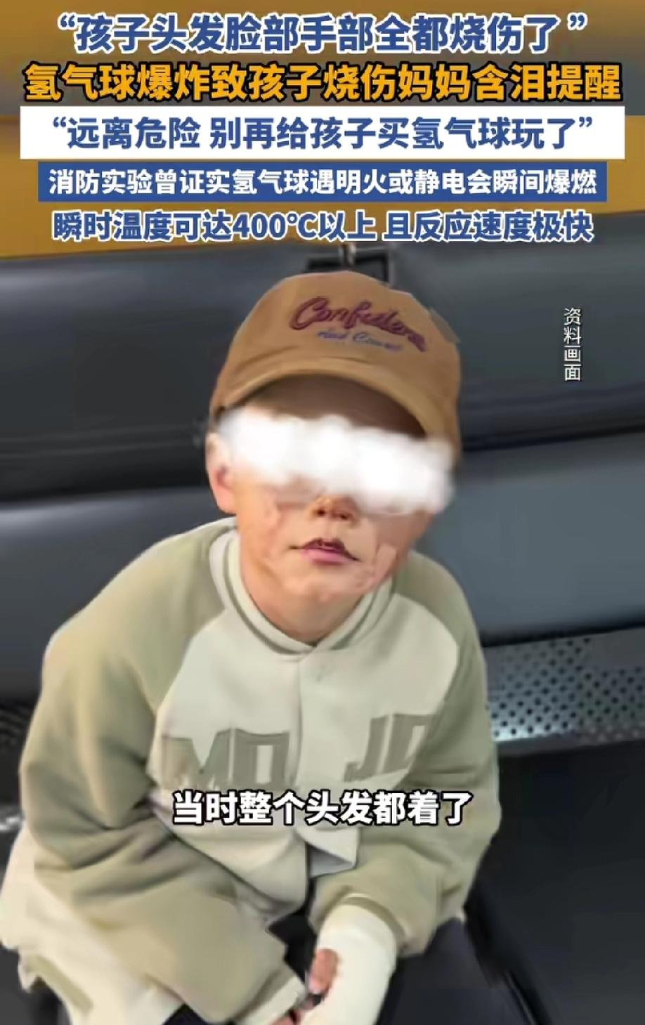 氢气球爆炸致孩子烧伤，妈妈含泪提醒大家远离危险，别给孩子买氢气球了。
河南平顶山