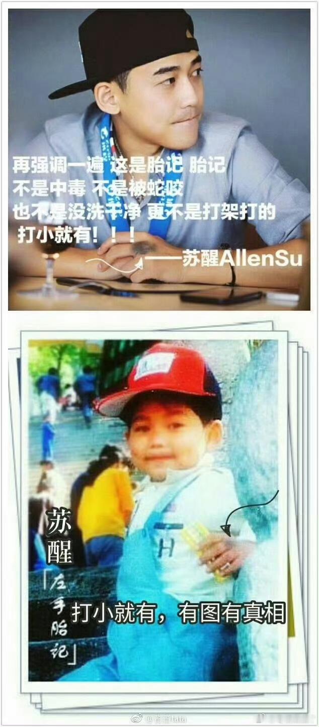 苏醒手怎么了全网猜测苏醒手淤青打架，热评一句话破案：那是与生俱来的左手胎记，醒子