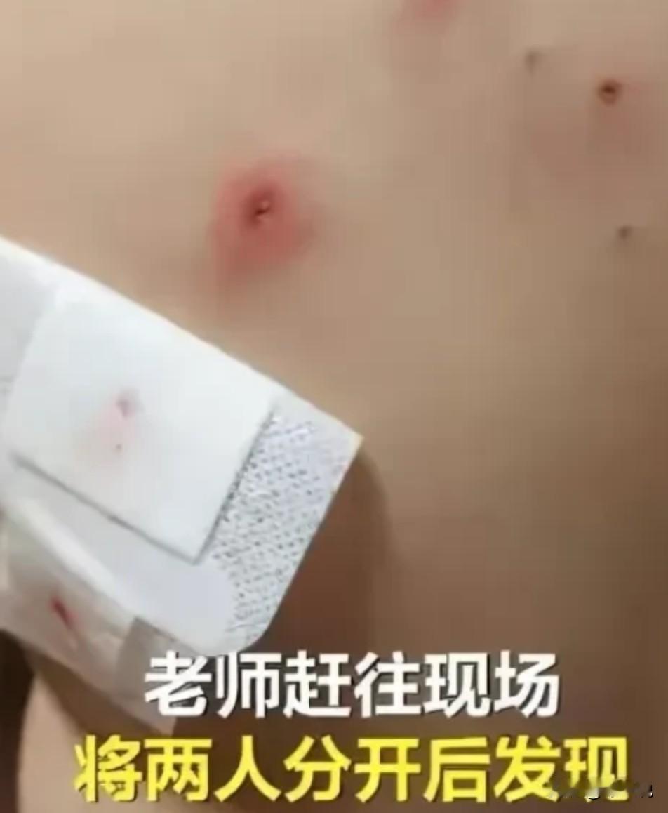 广东一女子在给7岁儿子洗澡时，发现儿子身上有多达20多个疑似针扎的血窟窿，校服上