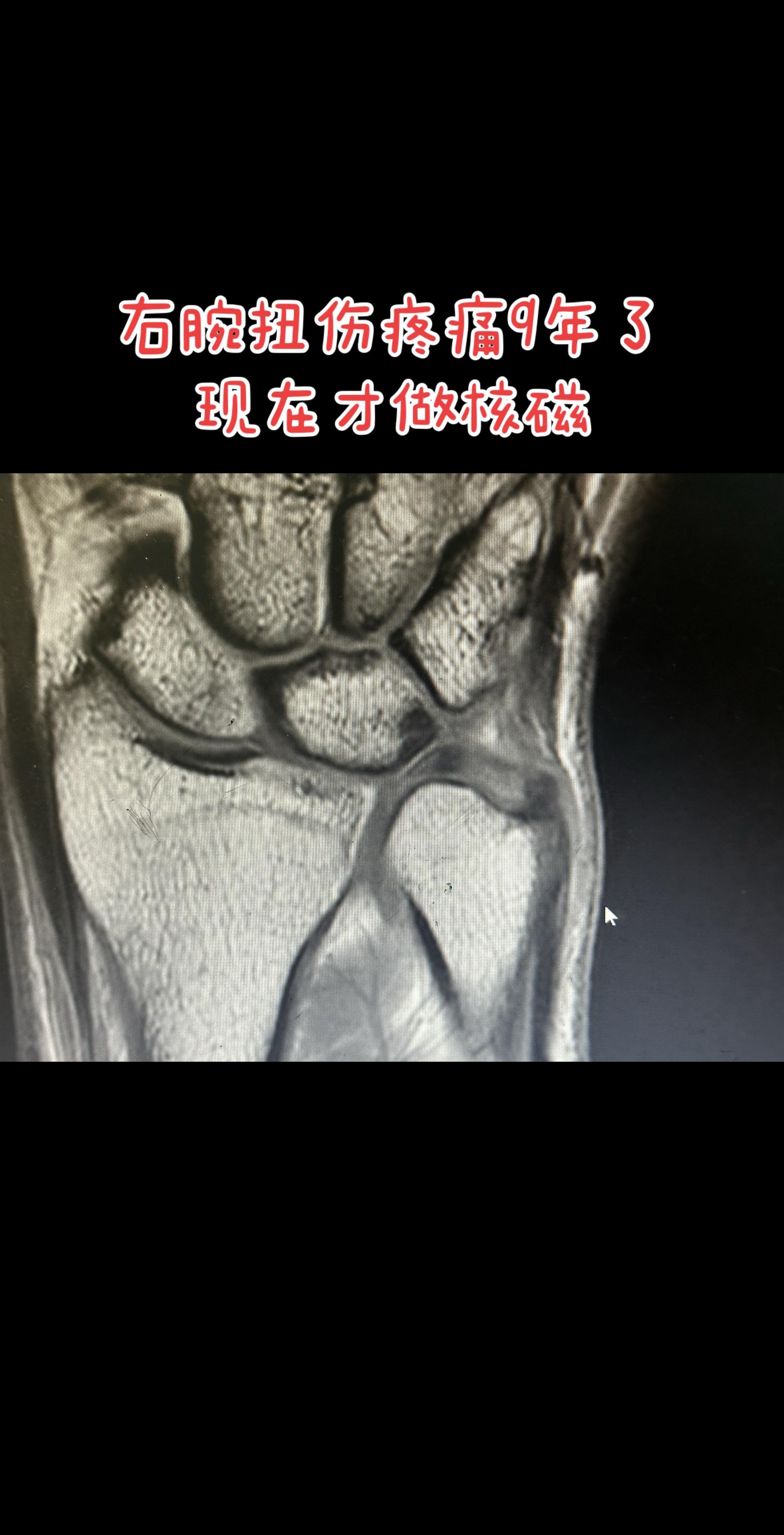 腕关节疼痛要注意TFCC损伤。拖了9年才诊断清楚的TFCC