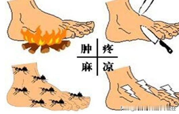 最近有不少的人问我，糖尿病多久会合并糖尿病周围神经病变。今天我就针对大家提出的问