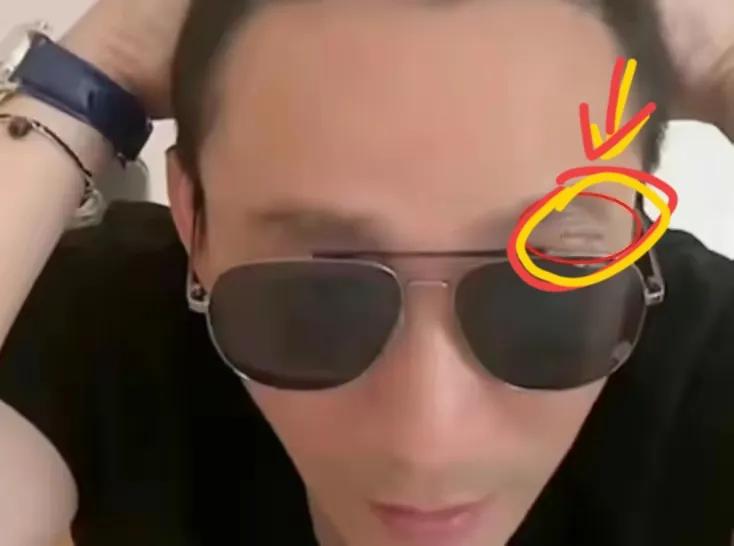 汪小菲，眼角突然受伤，伤口曝光触目惊心！

8月22日，人在台北的汪小菲，当着2
