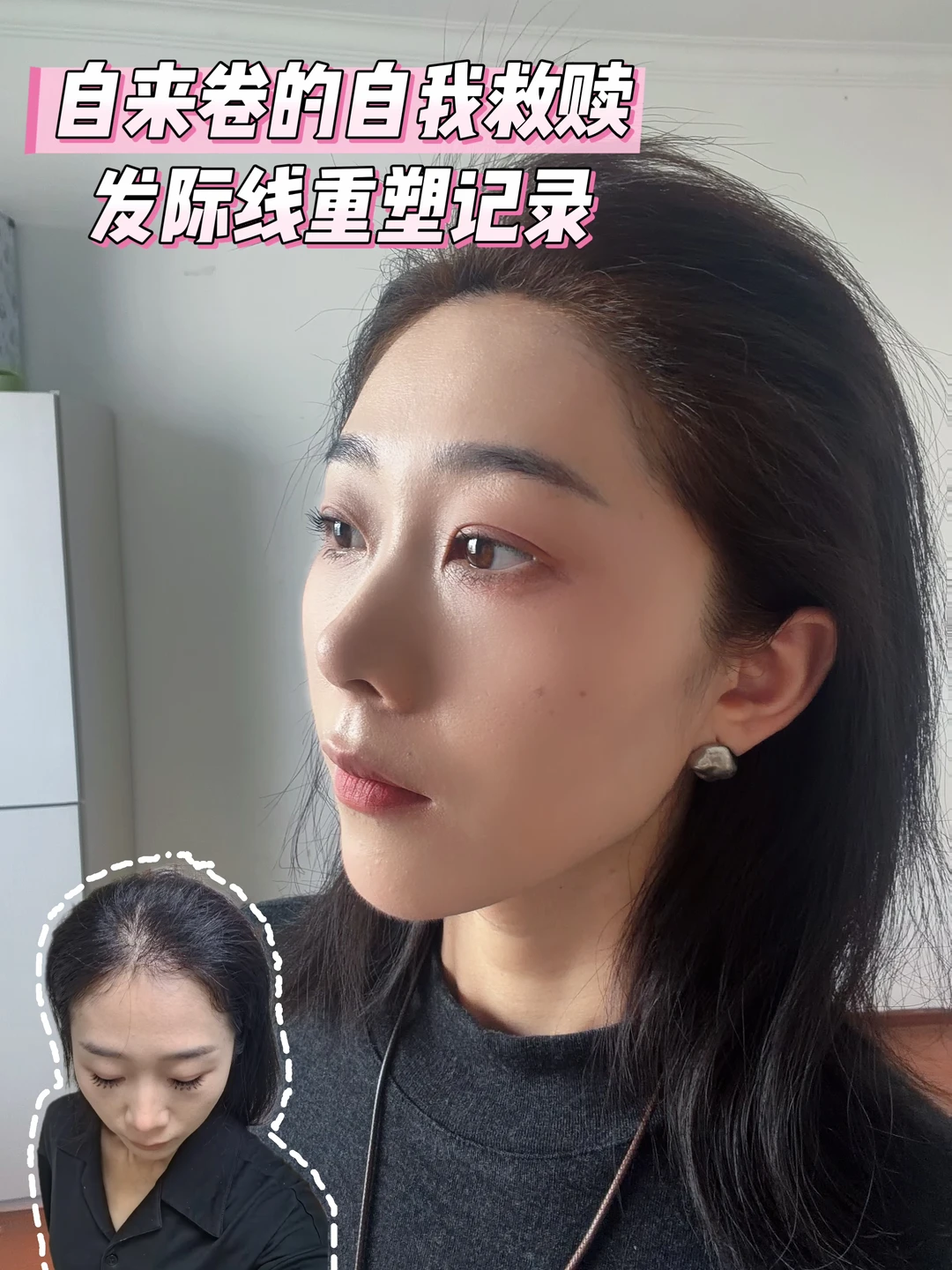 发际线才是小脸的神！健身四年也没让脸变小