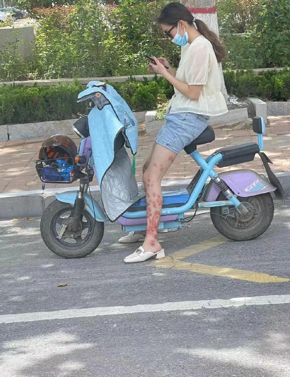 腿上这是怎么啦？