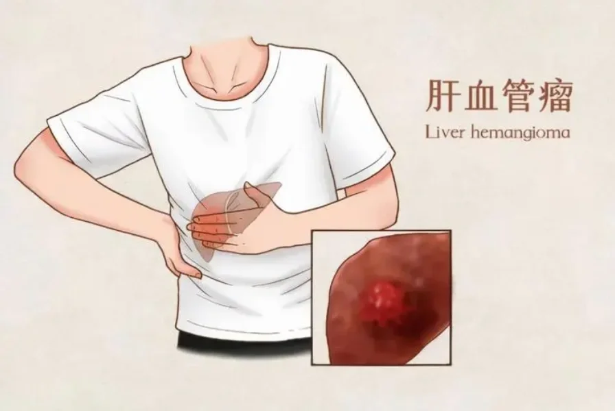 超声肝结节高回声-不一定血管瘤！也可能恶性