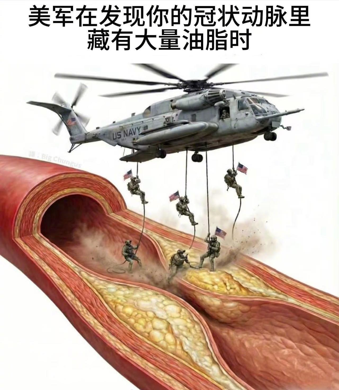 美军在发现你的冠状动脉里藏有大量油脂时...