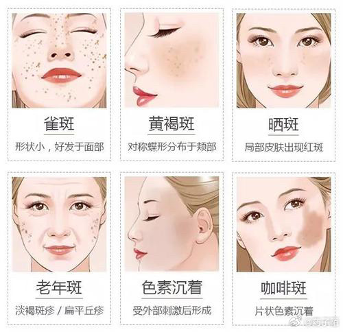 黄褐斑、雀斑、蝴蝶斑的克星不是护肤品，而是这个方子，从内到外好气色！爱美是每个人