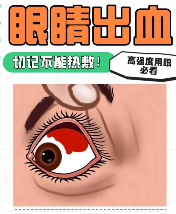 “眼睛突然出血”怎么办？如何治疗？
一觉醒过来，突然发现白眼球上突然有一块鲜红的