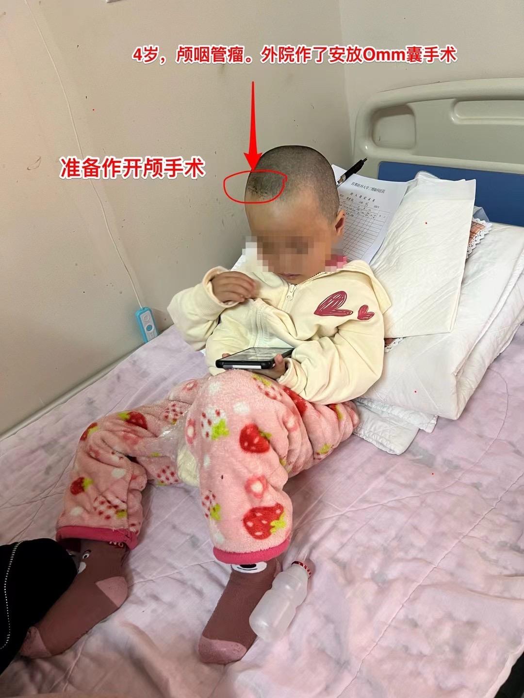 四岁怀化市女孩不幸遭遇了慢性硬膜下血肿。四岁女孩子因为右眼失明了，于今...