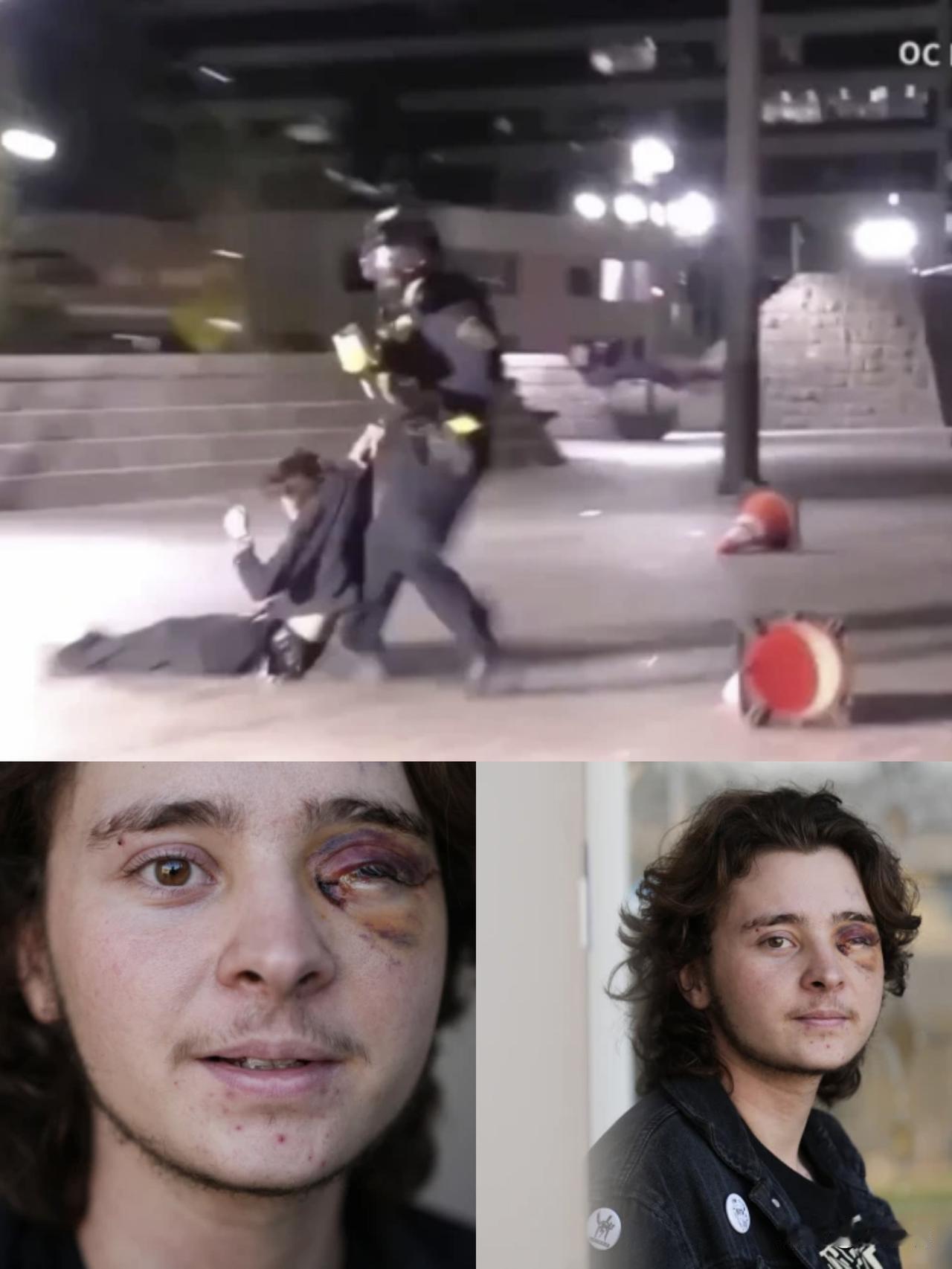 加州抗议者一只眼睛失明，在与联邦探员发生一系列暴力冲突中

一名21岁的大学生说