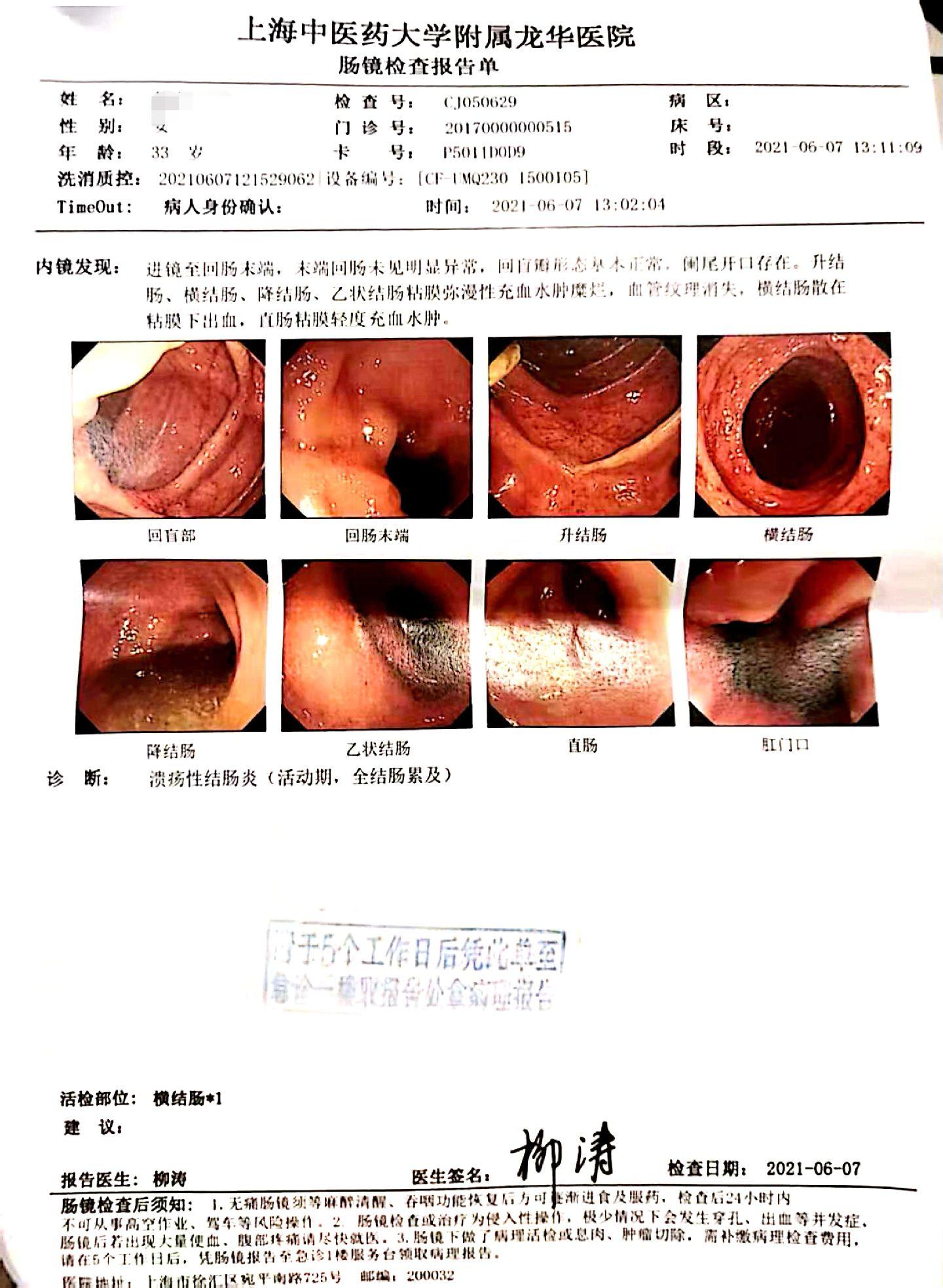 一年两年三年溃结患者维持缓解就会越来越好。溃疡性结肠炎的患者，最重要的就是维持无激素的缓解。