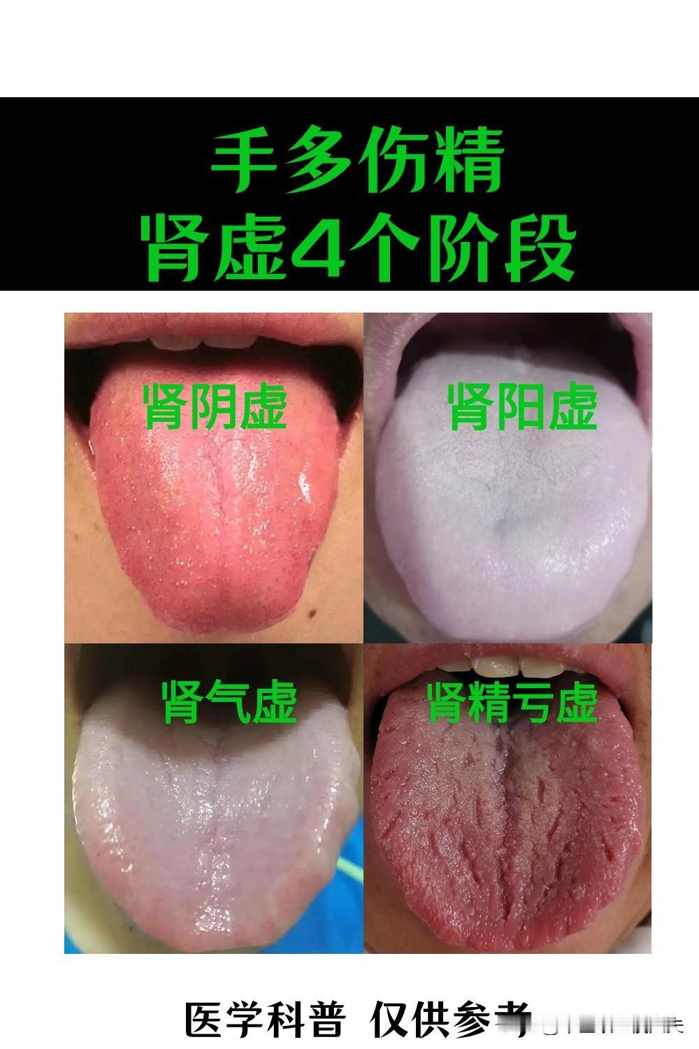 手动伤精，肾虚的4个阶段，今天郭医生一次给大家讲明白！[吃瓜群众][吃瓜群众][