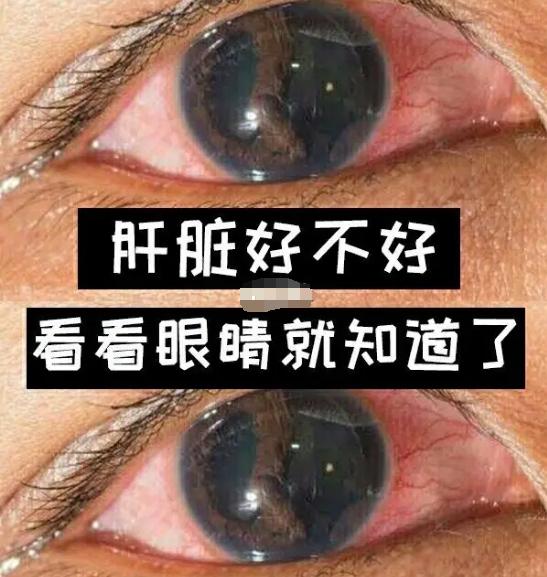 肝不好，眼先知   快看看你的肝脏是否健康

① 视线模糊——肝血不足
② 眼睛