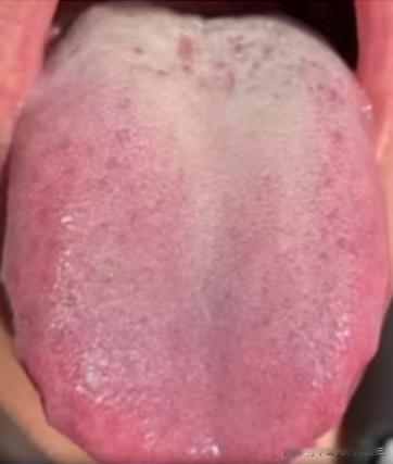 这种舌象，调理需谨慎，要以健脾，交通心肾为主

之前遇到一个男同志，当时他来的时