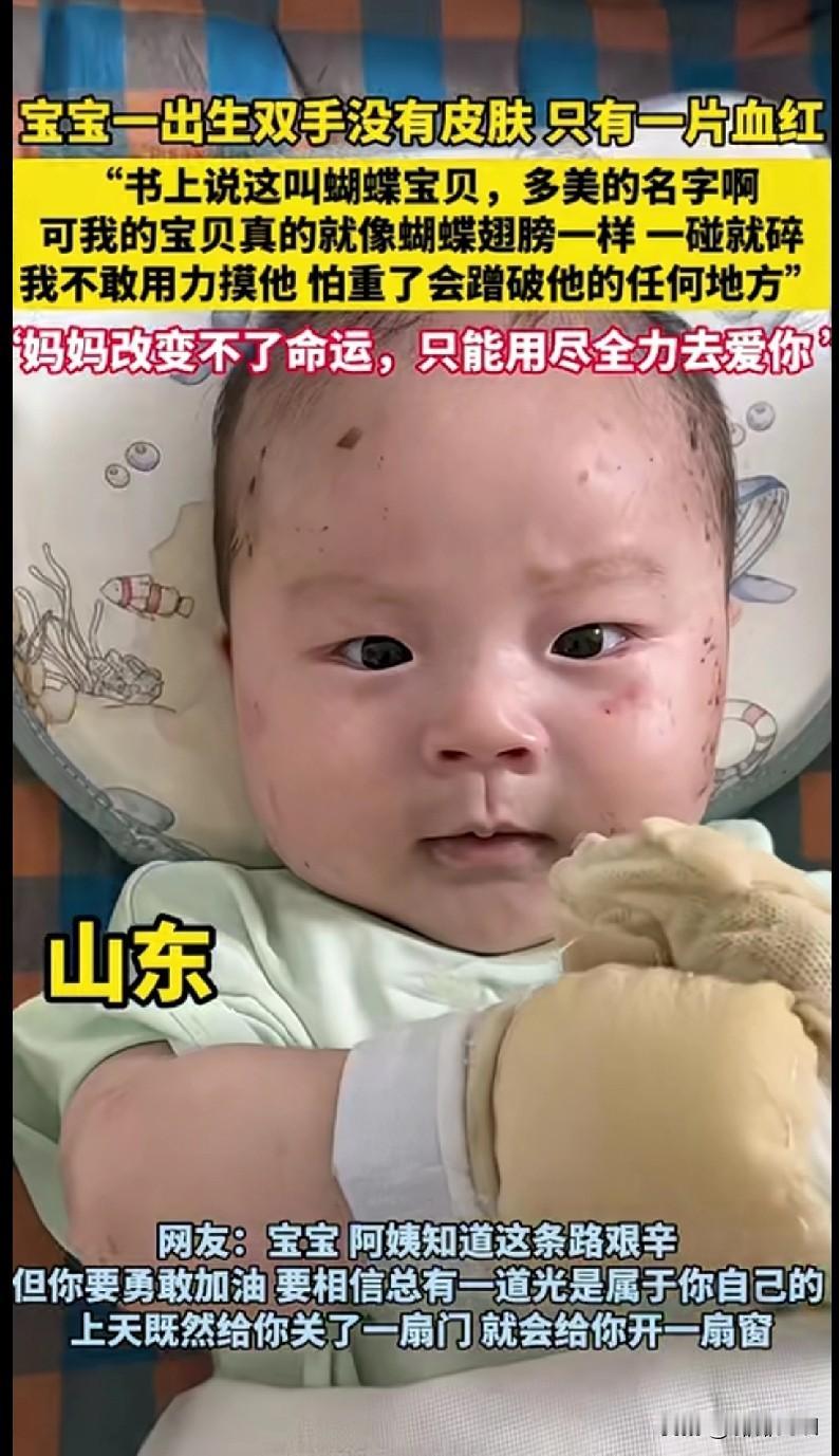 “山东这个刚出生的宝宝，双手没有皮肤，只有一片血红… 妈妈说他是‘蝴蝶宝贝’，可