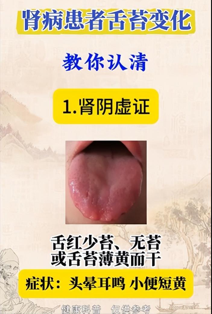 如何从舌苔看肾病？教你认清肾病患者的典型舌象