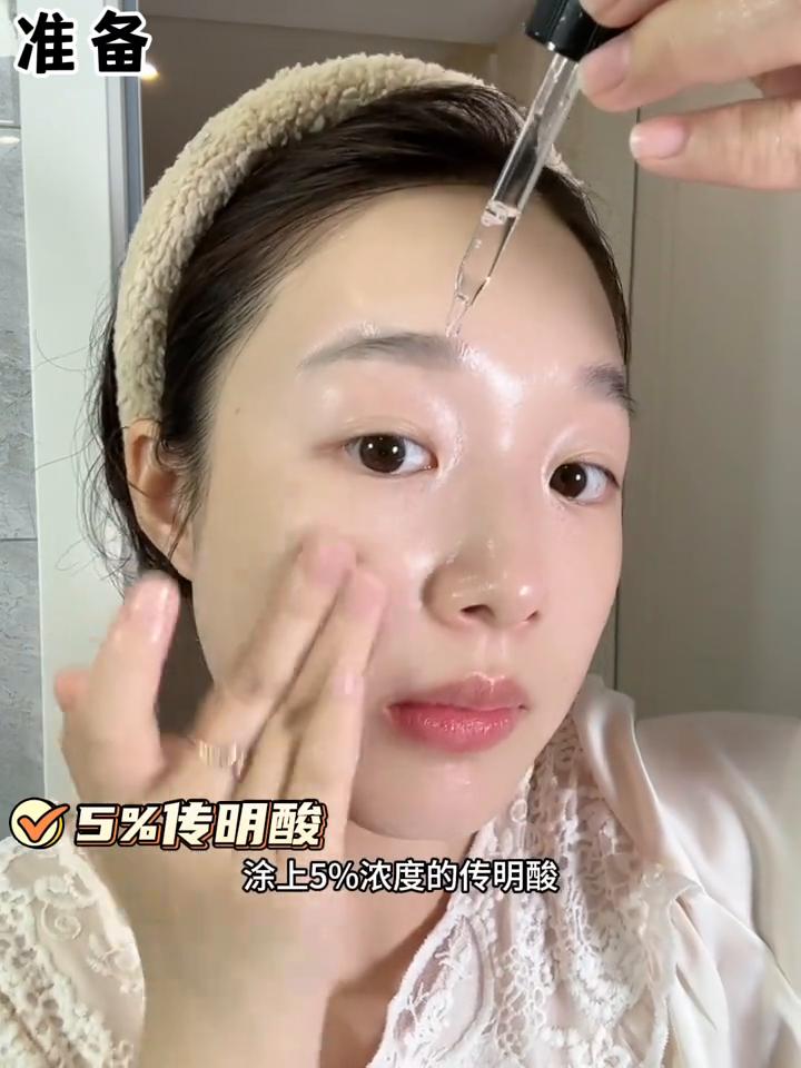 如果你跟我一样斑长在颧骨附近，打了斑还是反反复复，其实是气滞血瘀了。颧骨这边会经