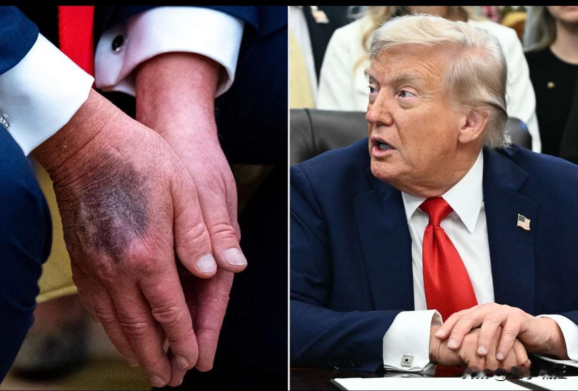 特朗普承认了……
​《华尔街日报》，刊登对特朗普专访，特朗普承认，每天服用大量阿