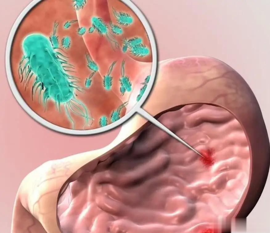 肠胃不好的表现，几乎全中，感觉快不行了①频繁排气：肠内有害菌就会产生大量硫化气体