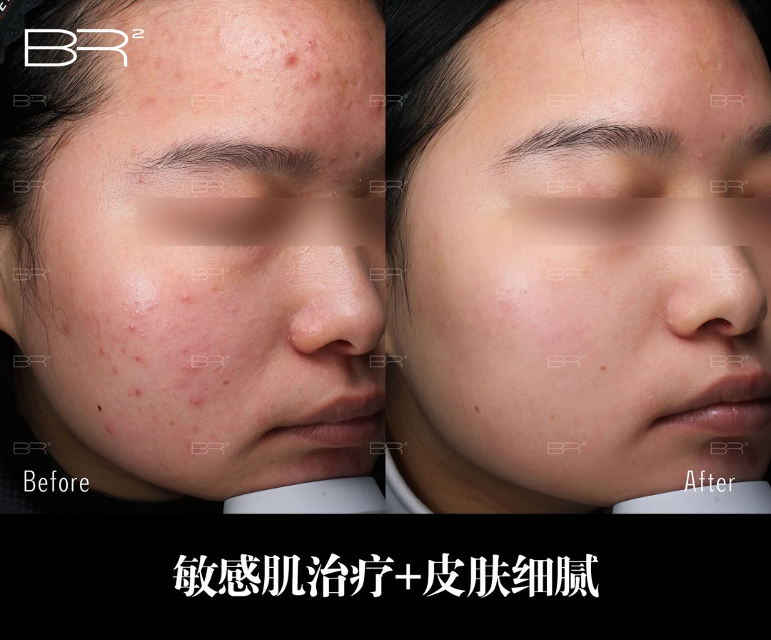 有个来咨询的姐妹问我为什么她每年都花小一万打光子和水光，夏天也做海菲秀，但是皮肤