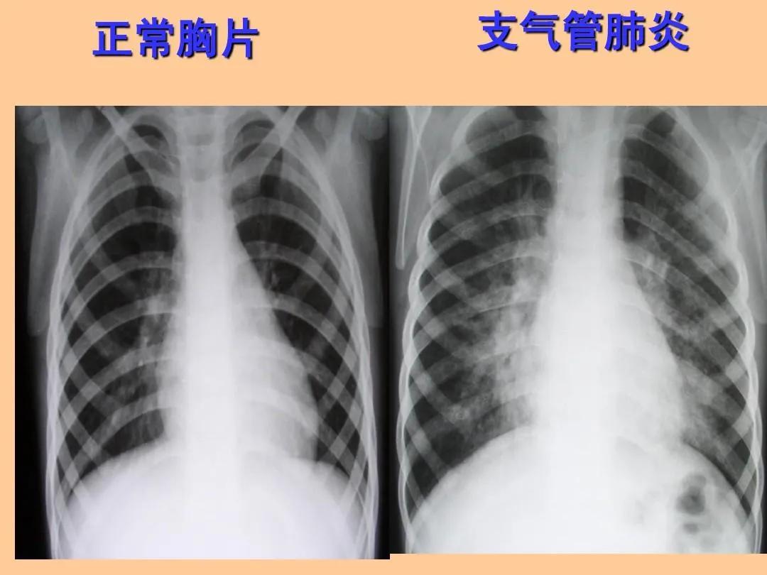 支气管肺炎已经大面积扩散了吗，怎么这么多人得呢？！
最近隔壁单位有十几个人因为患