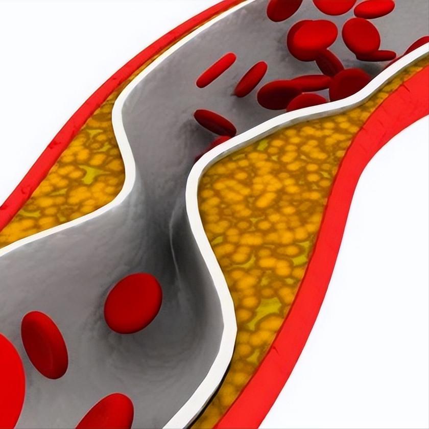 三个部位反复疼痛，可能是血管在“求救”
血管堵塞不是一朝一夕形成的，它在进展过程