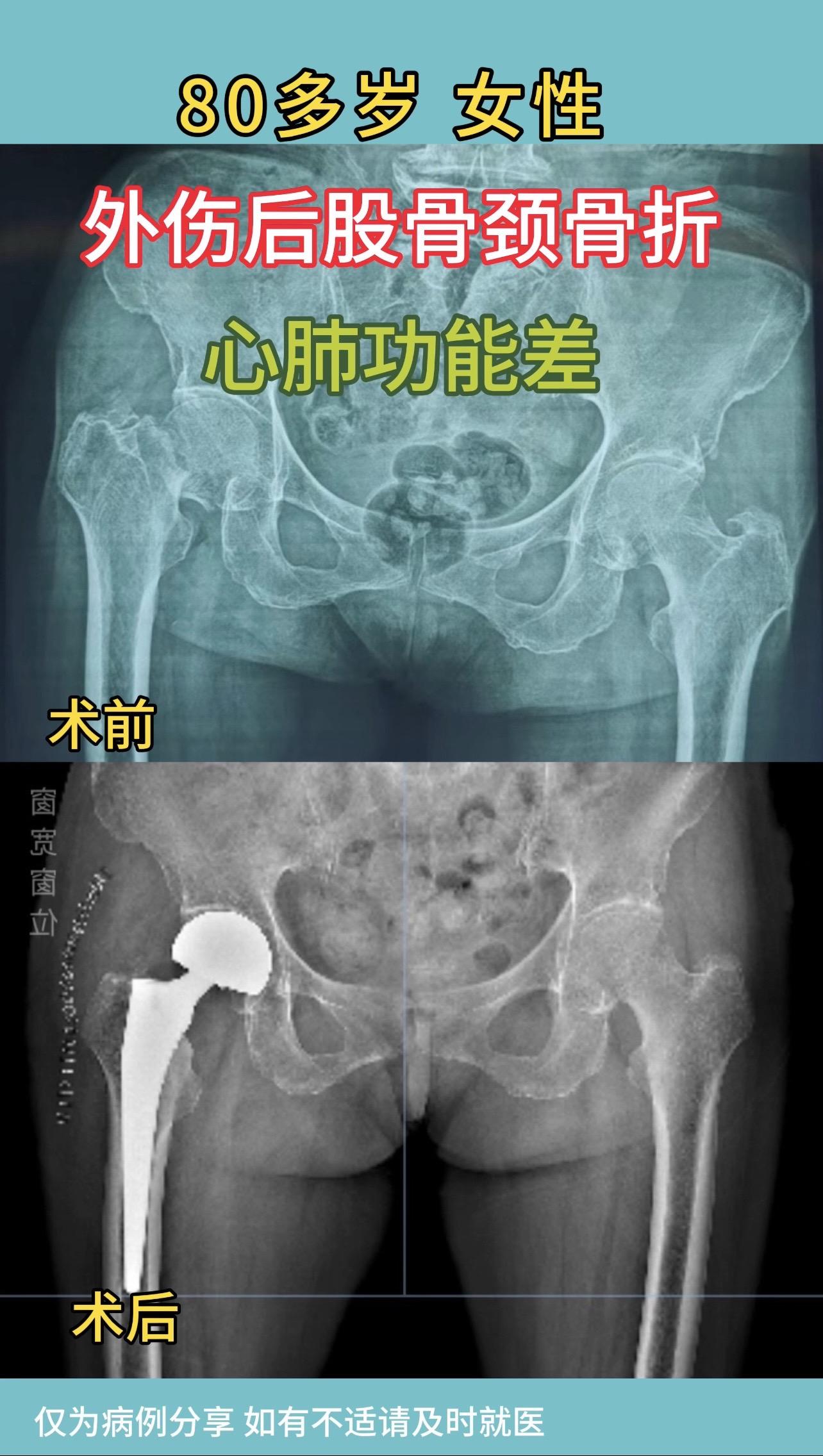 80多岁女性，外伤后股骨颈骨折，心肺功能差，原计划腰麻，但患者长期口服...