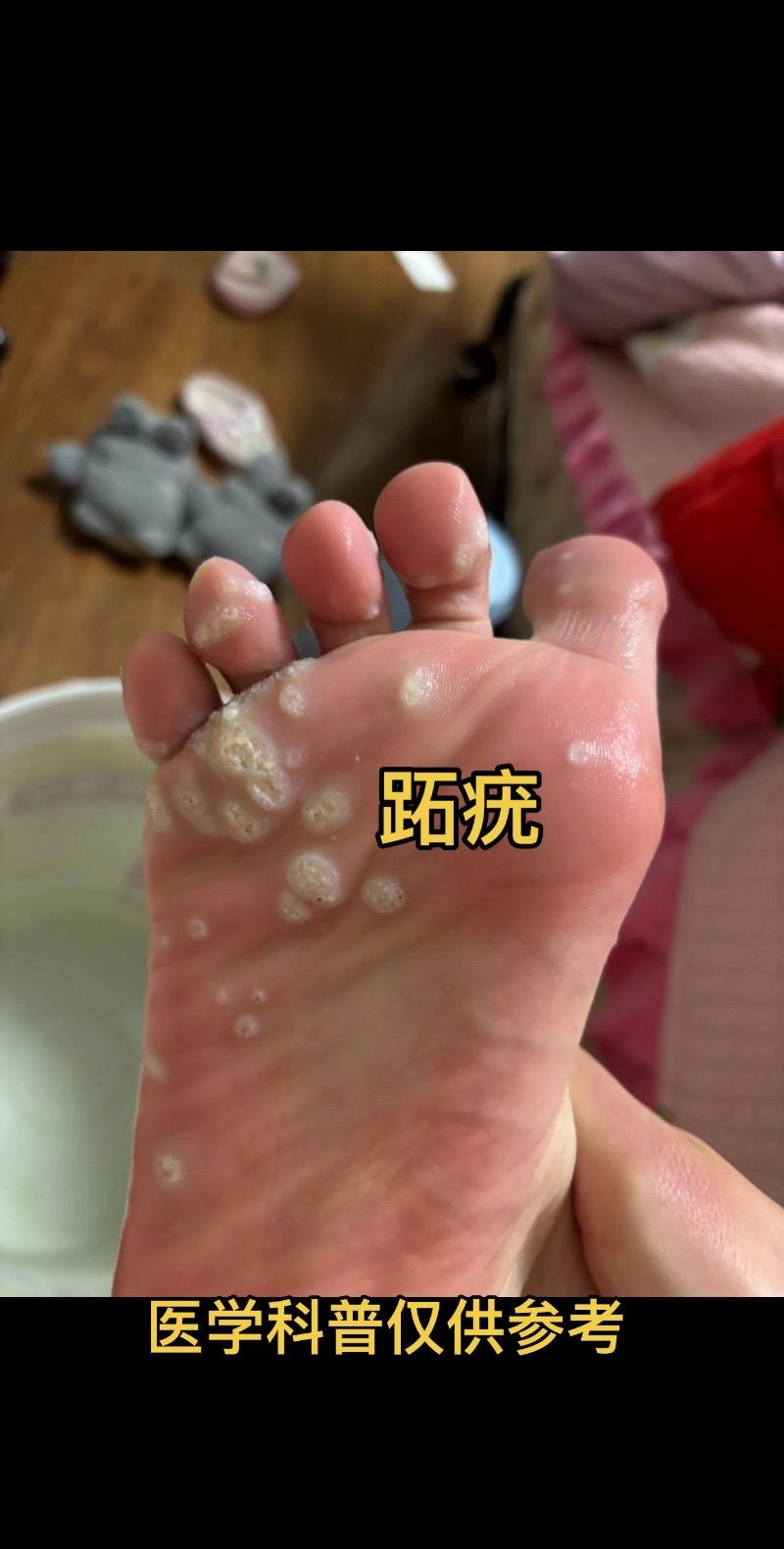 家长说小孩子脚底长了好多鸡眼，贴了鸡眼贴之后没有任何效果，这其实是跖疣...