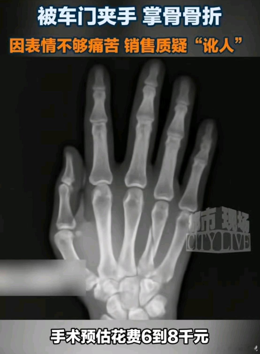 被车门将掌骨夹骨折，这有点夸张了吧