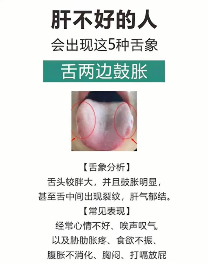 经常烦躁、胁肋胀？看看舌头，肝脏或许发出信号