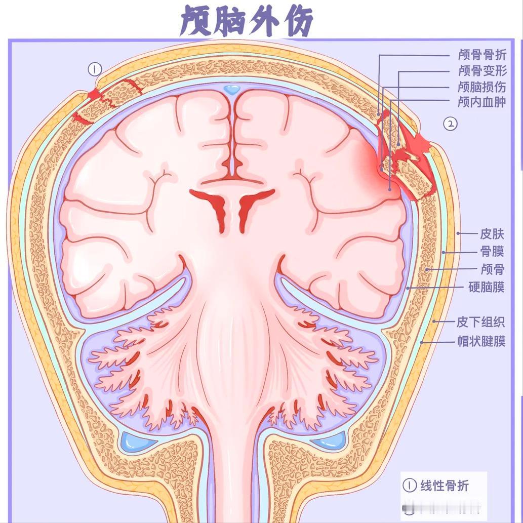 脑外伤和脑出血到底哪个更严重？终于说出大实话！

经常有家属着急地问：“医生，是