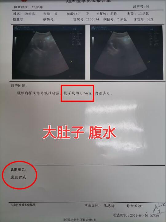 肝硬化患者腹水3.7cm严重吗？