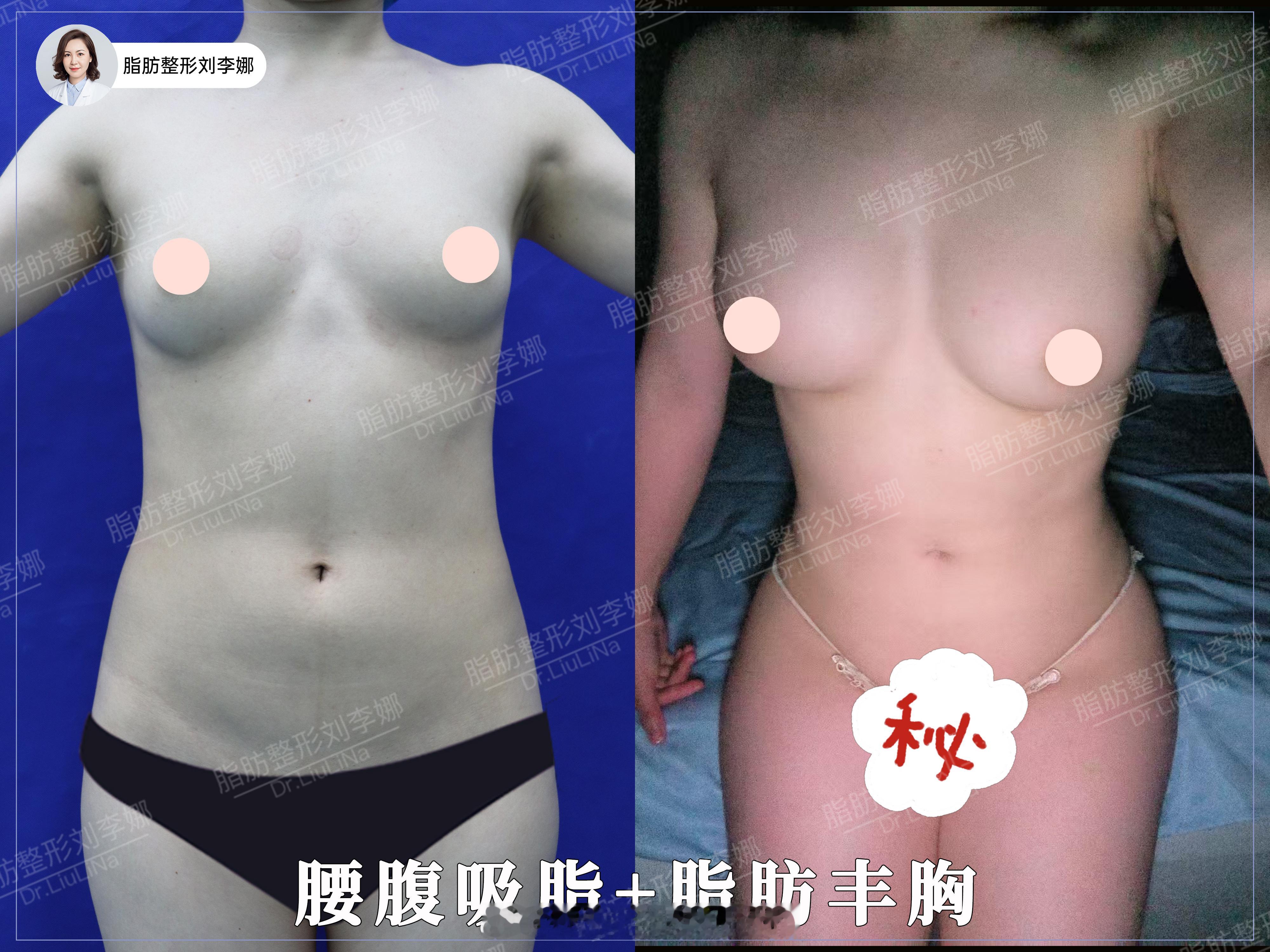 脂肪整形刘李娜 腰腹吸脂 自体脂肪丰胸  腰腹环吸+脂肪丰胸术后真实案例对比把腰