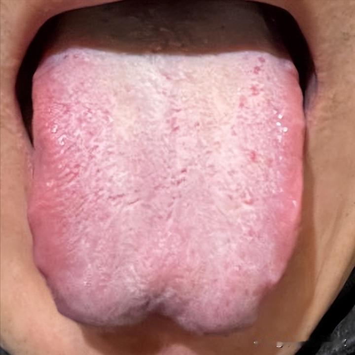 舌两边都红肿成这样了！火气那么大，脸色能好才怪呢！[狗头][狗头][狗头]
这位