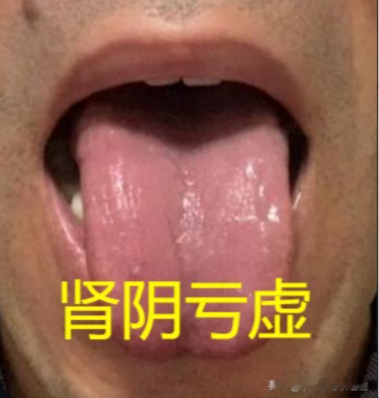 今日舌诊分析：
只需1分钟教你学会舌诊，一次分清阴虚，阳虚，肾精亏虚，肾气不足！