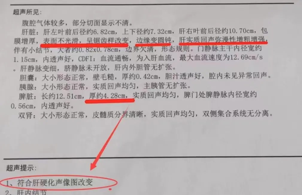 淄博肝硬化患者留言：袁教授你好，我是去年确诊的早期肝硬化，是因为长期酗...