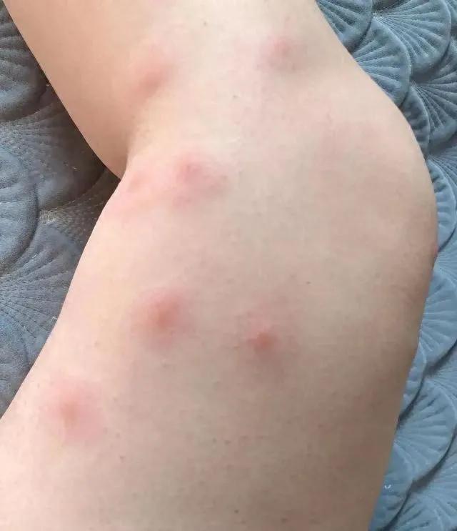 一群人中，蚊子为何只咬你？其实与血型无关，真正的缘由有 4 个

很多人以为蚊子