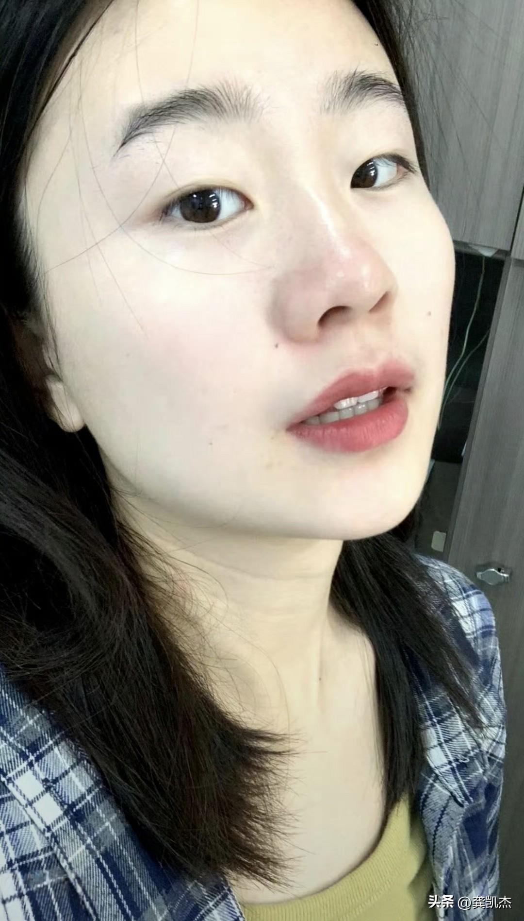 单眼皮手术成双眼皮，算成功的案例吧！