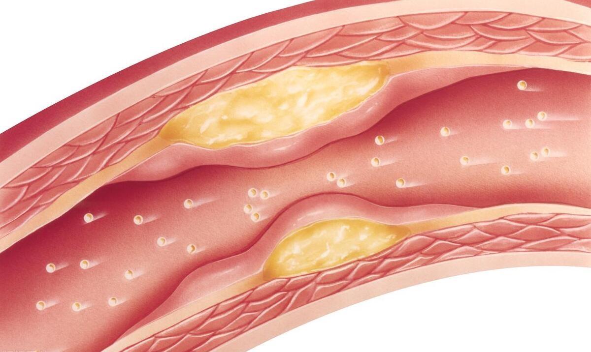 为什么降脂治疗，常用他汀呢？

很多人问，为什么总是在强调他汀，而很少提其他降脂