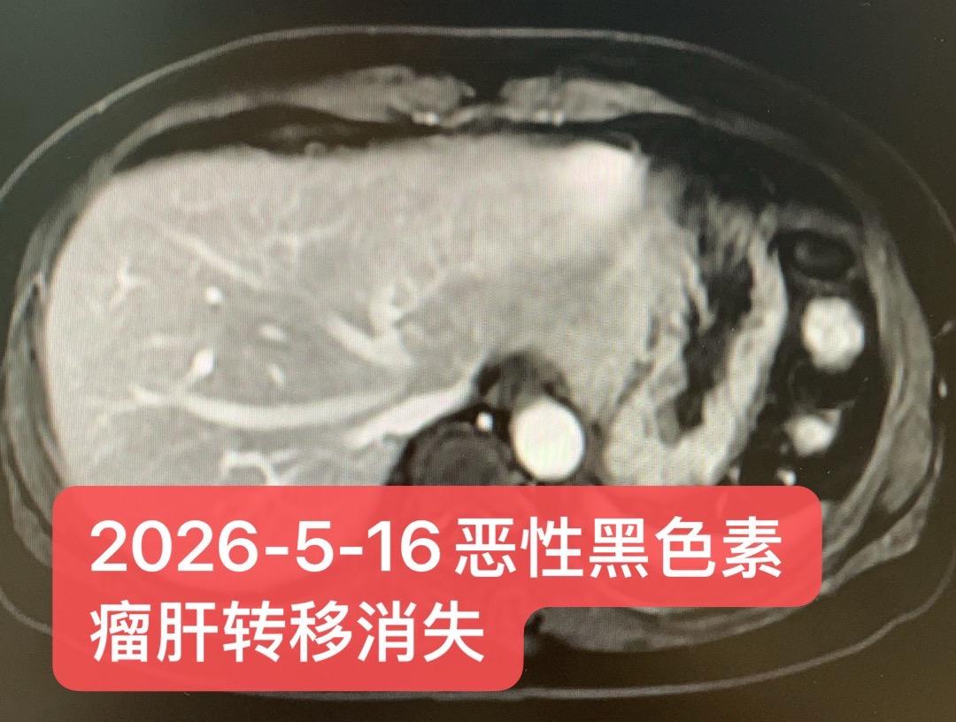 晚期恶性黑色素瘤12年：接近无瘤。患者女性，57岁，2014年：确诊右...