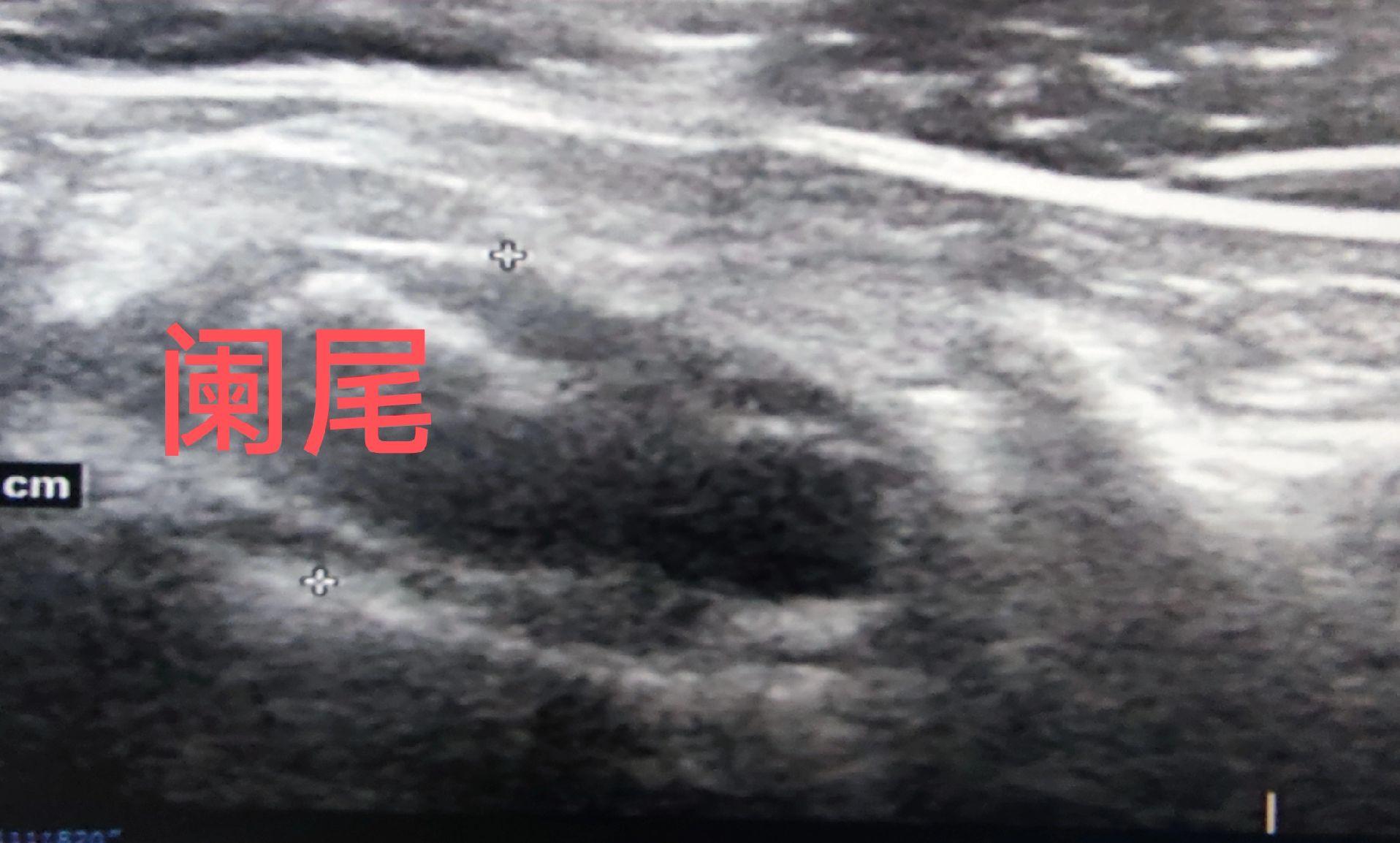阑尾肿大。阑尾炎性改变
后位阑尾
盲端较难显示
与CT对照
随访化脓性阑尾炎已手术