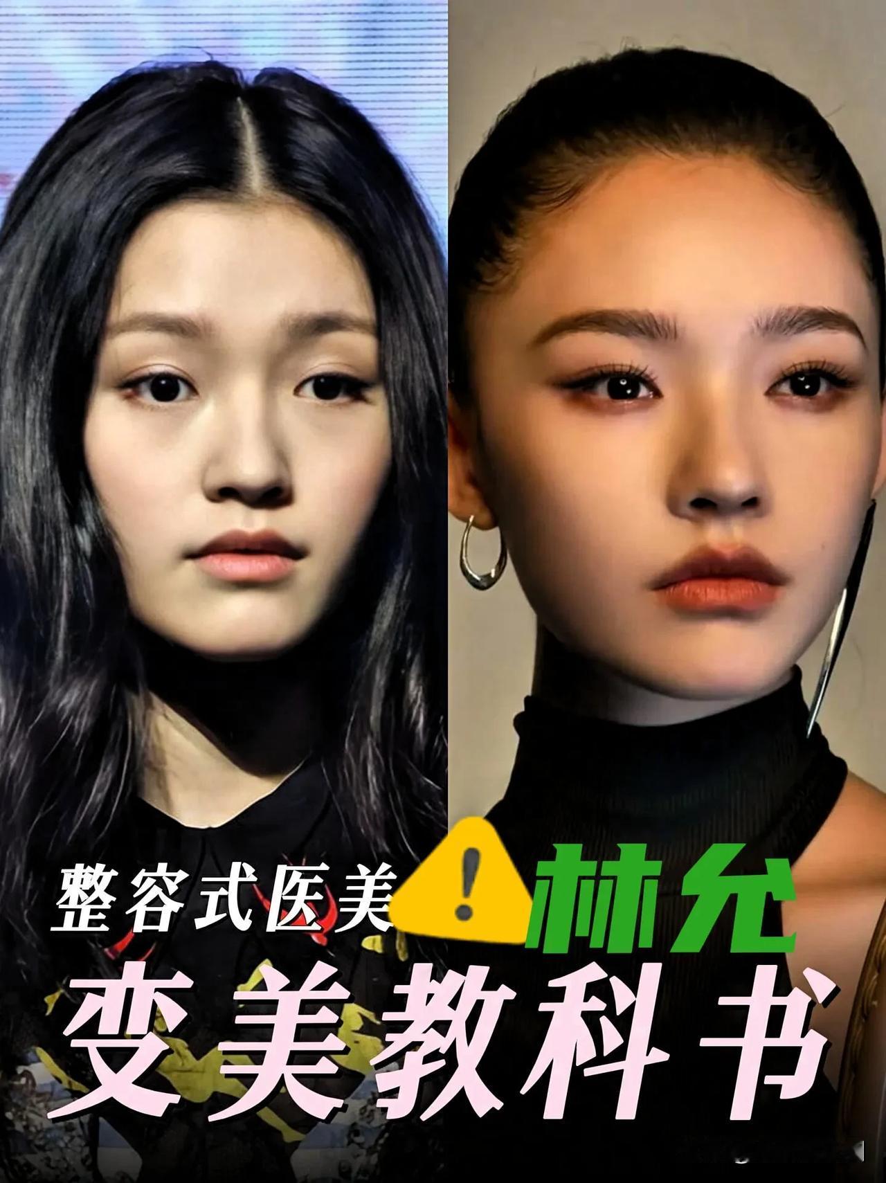 林允这张脸没少花钱吧！早年土鳖婴儿肥的青涩脸庞，如今惊艳立体精致的骨相美，整得自