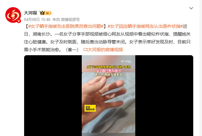 女子晒手指被劝去医院果然查出问题 长沙女子发布手部视频，细心网友看出疑似杵状指，
