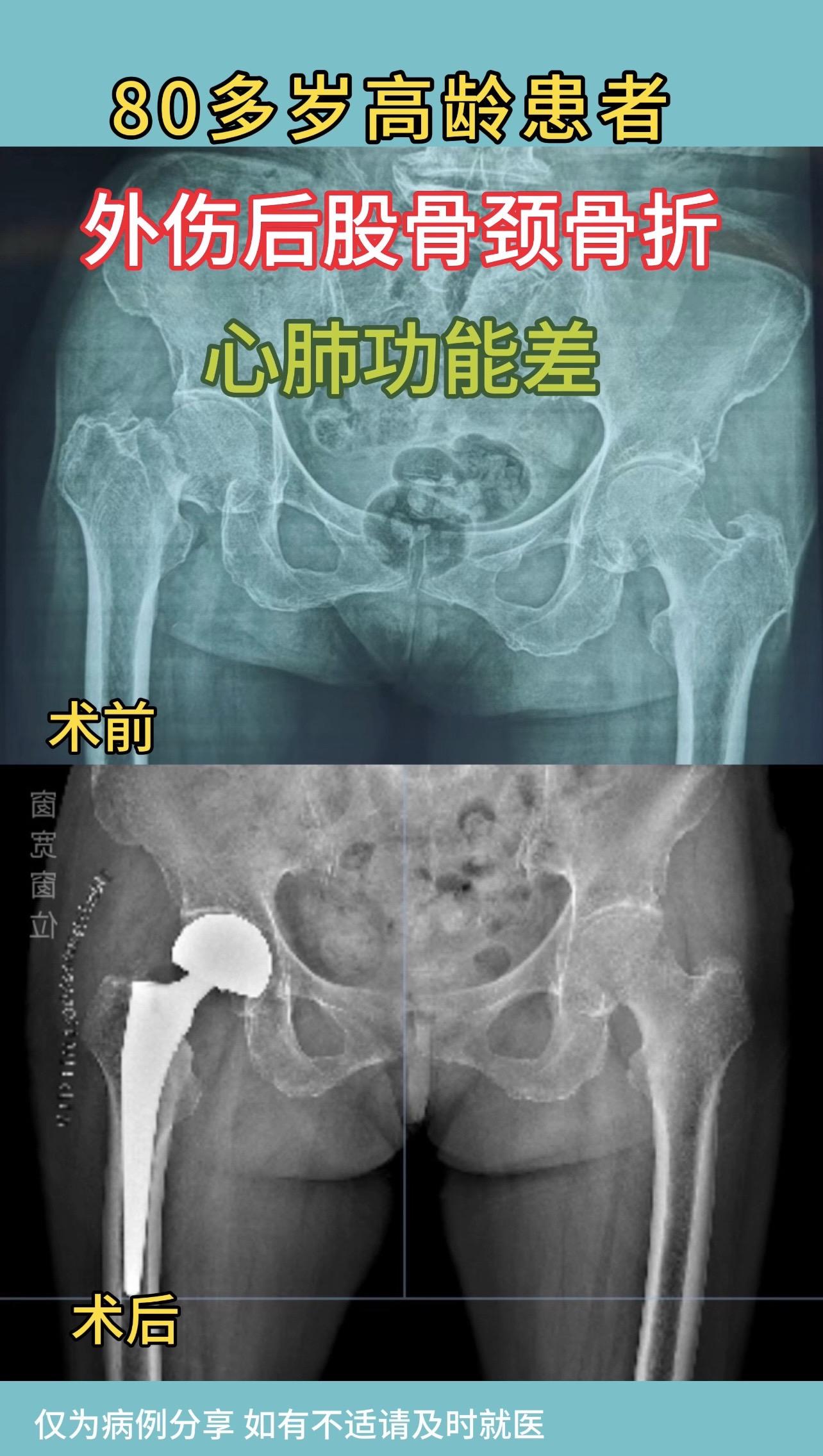 80多岁女性，外伤后股骨颈骨折，心肺功能差，原计划腰麻，但患者长期口服...