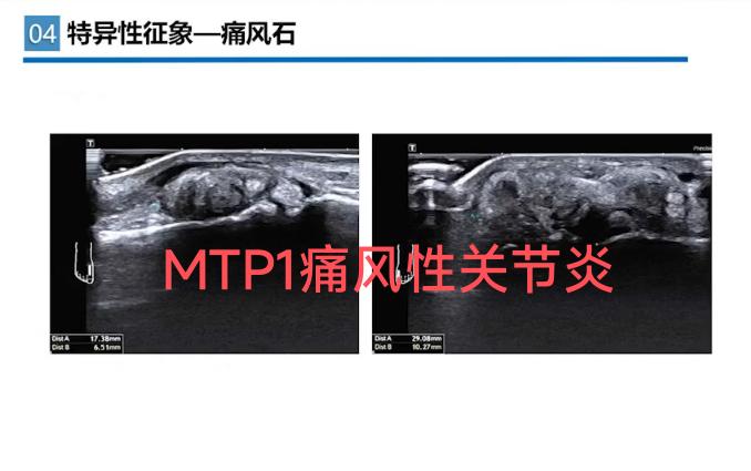 痛风关节炎超声。双轨征是特异性征像 滑膜增生是非特异性征像