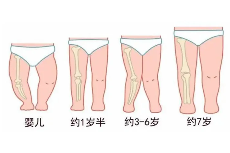 小孩正常腿型发展图