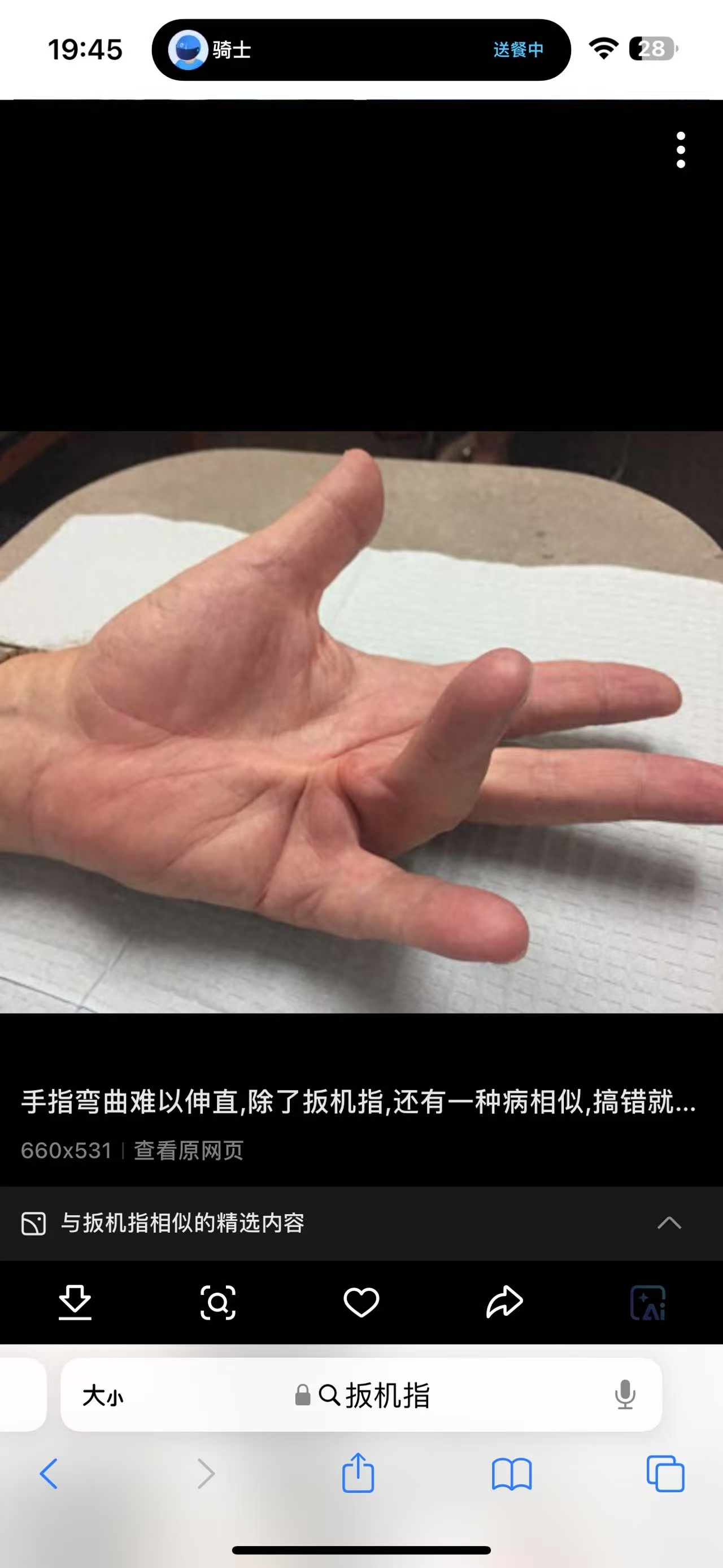扳机指 我们北京奥森门诊的赵老师，最近评估了一个双手中指扳机指的阿姨常见的扳机指